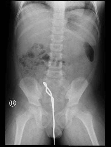 Học theo phim ảnh, bé trai 5 tuổi nhét thanh sắt vào hậu môn-1