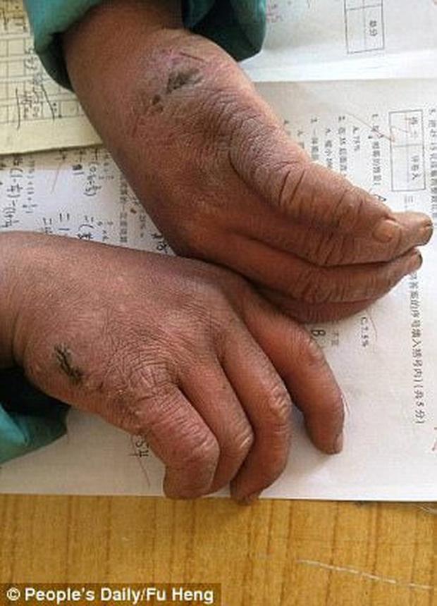 Cuộc sống cậu bé đóng băng khiến cả châu Á đau lòng 4 năm trước-6