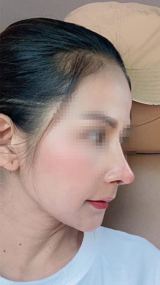 Già vẫn ham hố nâng mũi, bà mẹ nhận kết thảm thương-3