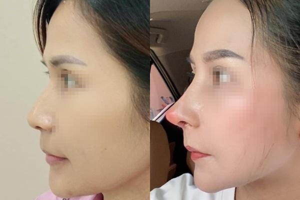 Ham hố tiêm filler, gái xinh vĩnh biệt đôi môi đón Tết-7