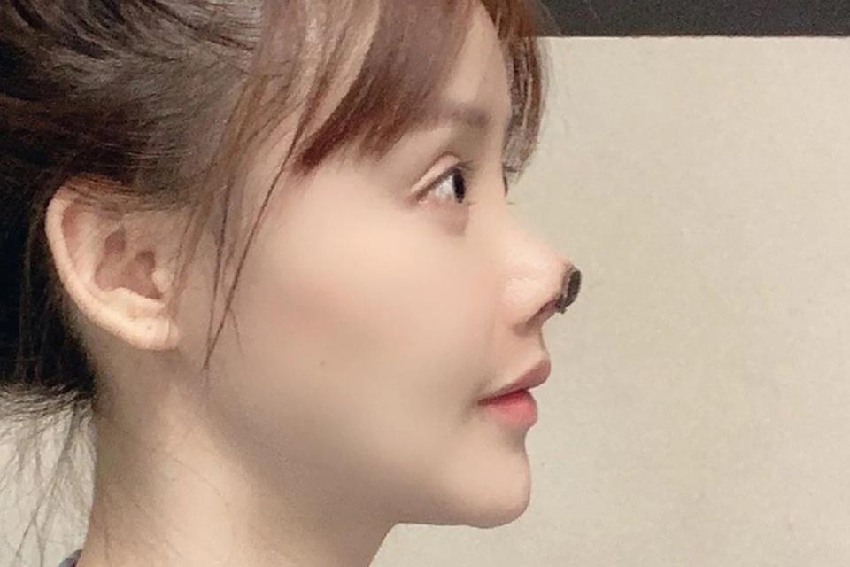 Trào lưu phẫu thuật thẩm mỹ bữa trưa-3