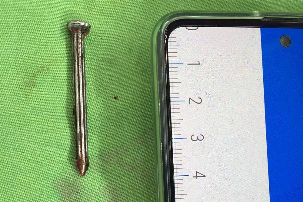 Người đàn ông ở Vĩnh Long tự lấy đinh đóng vào đỉnh đầu-1