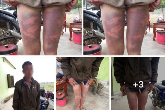 Vụ dân tố bị còng tay đánh bầm tím: Người nhà công an mang 5 triệu đến?