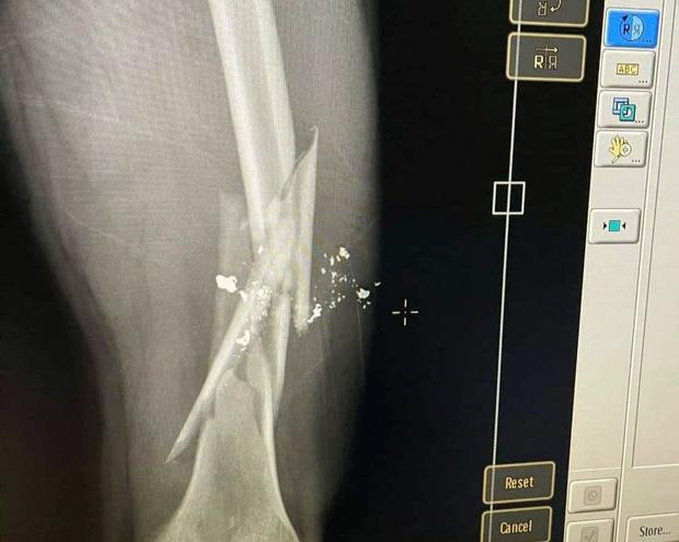 Mâu thuẫn trong quán ăn, dùng súng bắn gãy xương đùi bạn nhậu-1