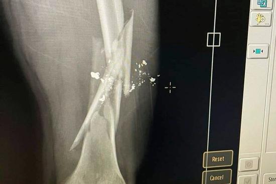 Mâu thuẫn trong quán ăn, dùng súng bắn gãy xương đùi bạn nhậu