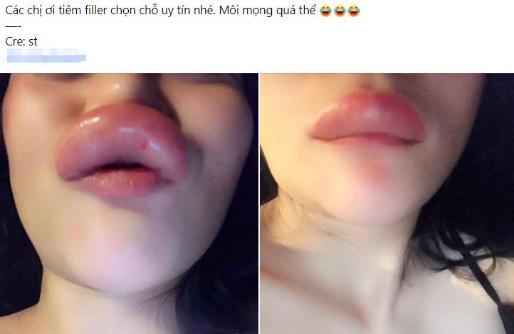 Ham hố tiêm filler, gái xinh vĩnh biệt đôi môi đón Tết-1