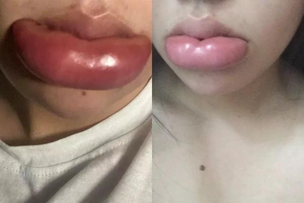 Ham hố tiêm filler, gái xinh vĩnh biệt đôi môi đón Tết-2