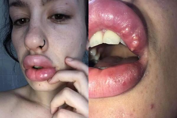 Ham hố tiêm filler, gái xinh vĩnh biệt đôi môi đón Tết-5