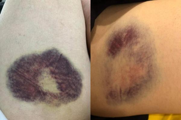 Chị vợ tố Gia Thị Linh tiểu tam tung ảnh thương tích đầy mình-5