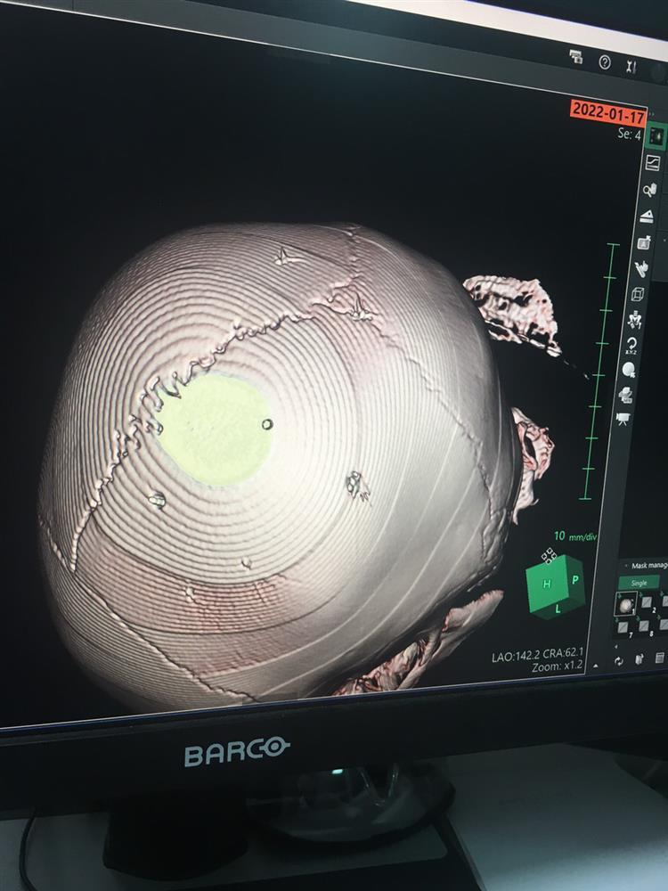 Bé 3 tuổi hôn mê, chụp X-quang 9 cái đinh cắm trong sọ não?-2