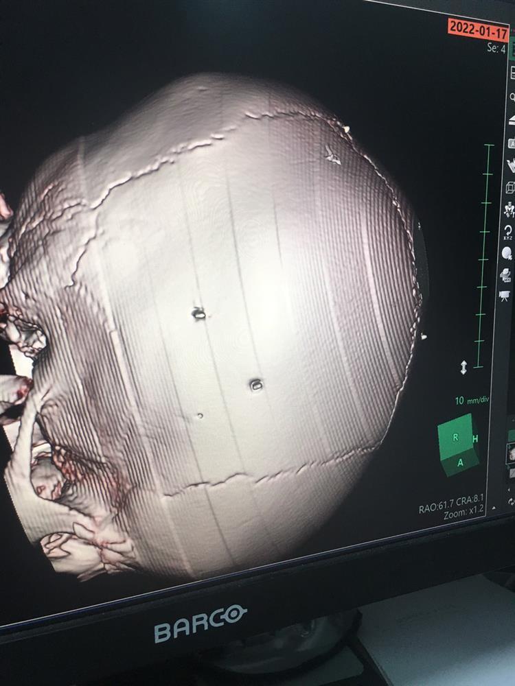 Bé 3 tuổi hôn mê, chụp X-quang 9 cái đinh cắm trong sọ não?-3