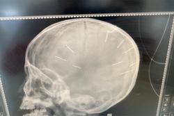 Bé 3 tuổi hôn mê, chụp X-quang 9 cái đinh cắm trong sọ não?