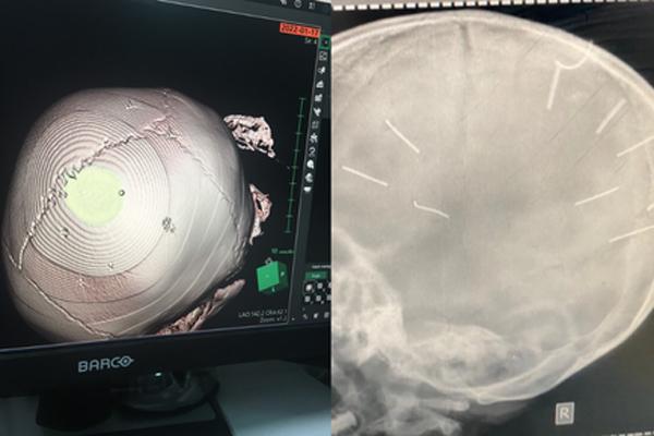 Cập nhật sức khỏe bé gái có 9 vật giống đinh trong đầu-2