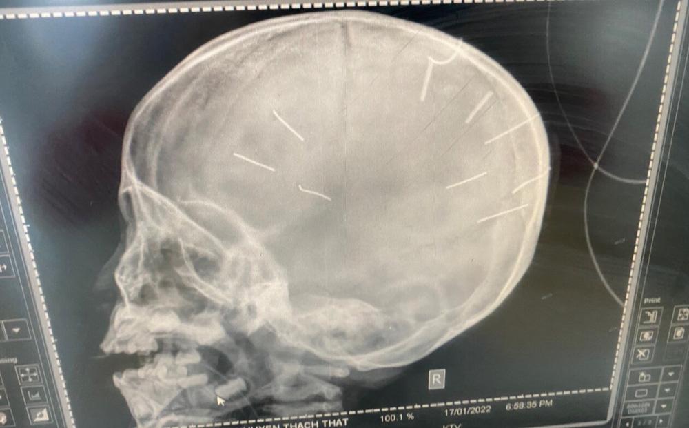 Cập nhật sức khỏe bé gái có 9 vật giống đinh trong đầu-1