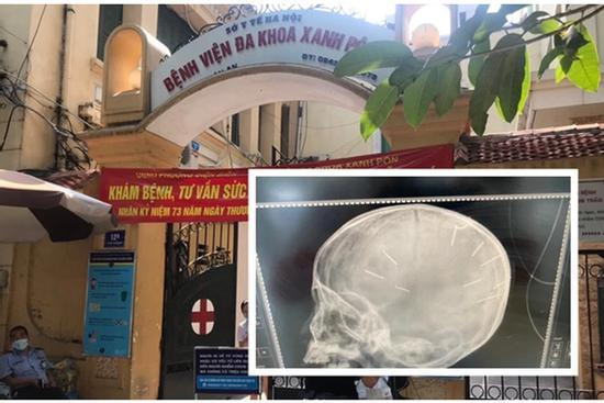 Bé 3 tuổi bị bắn 9 cái đinh vào não: Từng bị gãy tay, có đinh trong bụng