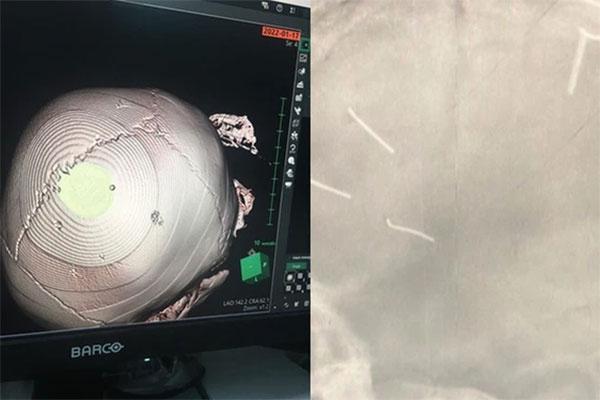 Thêm một bé gái 9 tuổi nghi bị chị dâu bạo hành... tím người-3