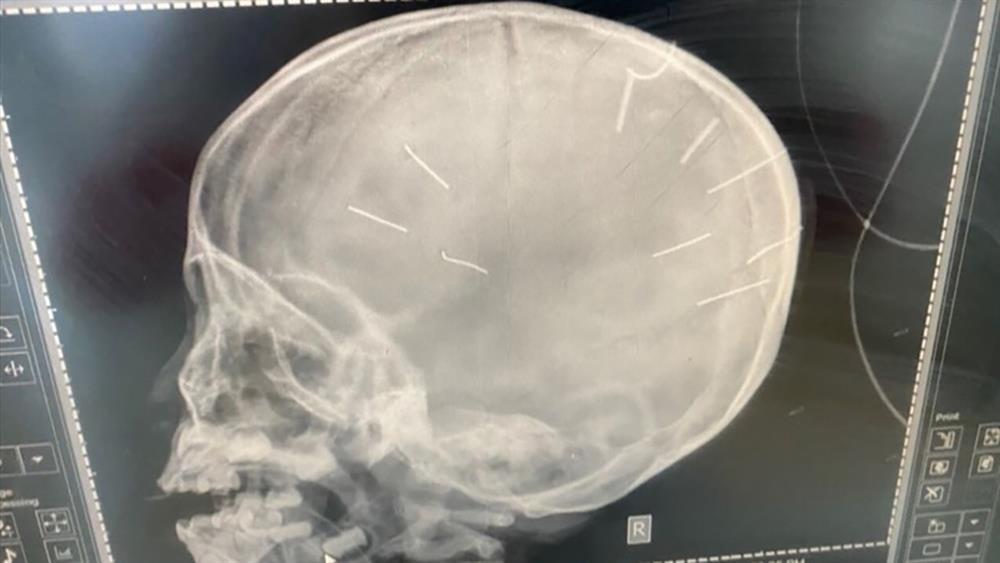 Bố bé gái 3 tuổi bị 9 cây đinh găm trong não: Tôi không ngủ nổi-1