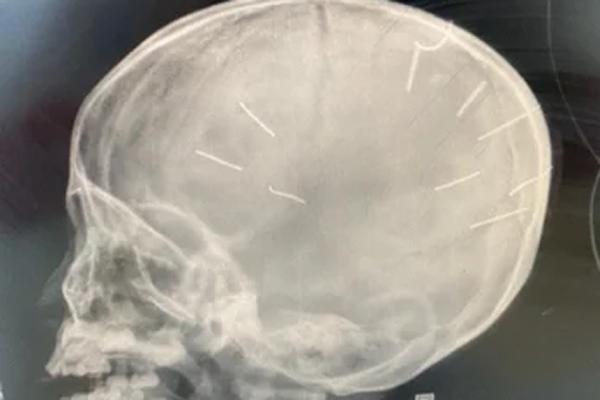 Cảnh sát hình sự Hà Nội điều tra vụ bé gái có 9 dị vật ở sọ não-1