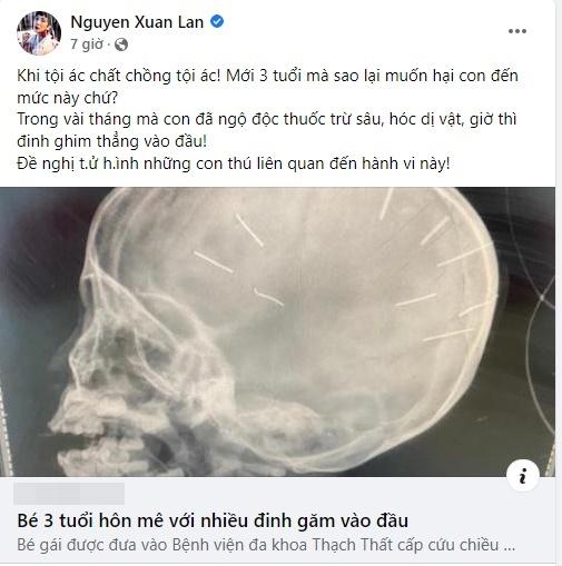Vụ bé 3 tuổi bị bắn 9 đinh vào đầu: Sao Việt phẫn nộ kẻ ra tay-3