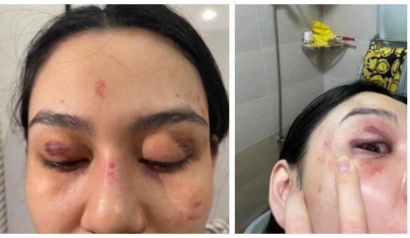 Nạn nhân bị hành hung tố Trang Nemo nói phét, chỉ làm màu-1