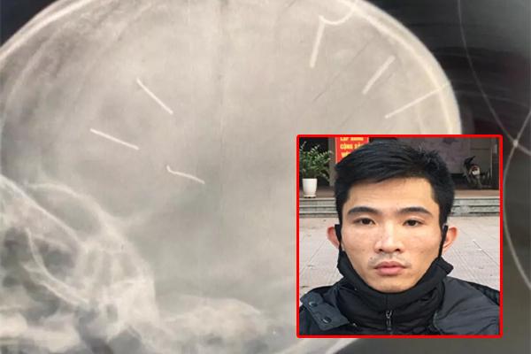 Bé 3 tuổi bị tình nhân của mẹ đóng 9 đinh vào đầu: Mẹ đang ở đâu?-7