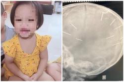 Bé gái 3 tuổi bị đóng đinh vào đầu được phẫu thuật thành công?