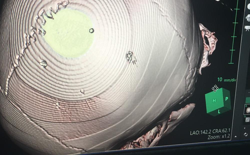 Rộ tin bé 3 tuổi bị đóng 9 đinh đã phẫu thuật thất bại: Sự thật là gì?-1