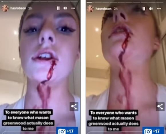 Bạn gái siêu sao Manchester United đăng video bị bạo hành máu me bầm tím-1