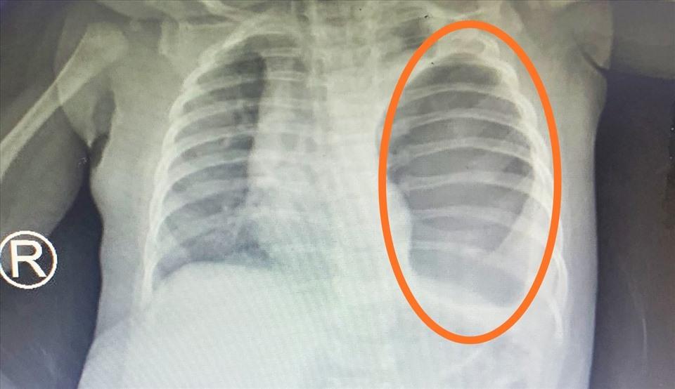 Té võng ngã, bé gái 4 tháng tuổi bị dạ dày chui lên lồng ngực-2