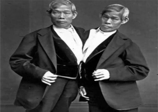 Cuộc sống vợ chồng của hai anh em dính liền thân kết hôn với cặp chị em song sinh-2