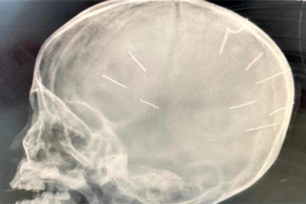 Bé gái 3 tuổi bị người tình của mẹ đóng đinh vào đầu hiện sức khỏe ra sao?-1