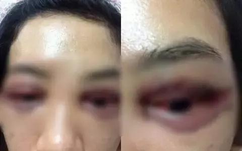 Ám ảnh pha cắt mí mắt lợn lành thành lợn què-8