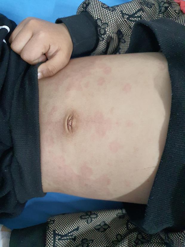 Bé trai mắc hội chứng MIS-C sau Covid-19, liên tục sốt cao mê sảng-2