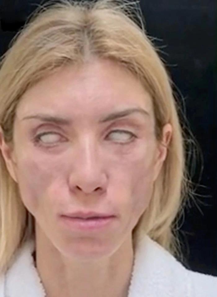 Á Hậu nghiện PTTM rồi chịu hậu quả mặt đơ, mắt trợn ngược-2