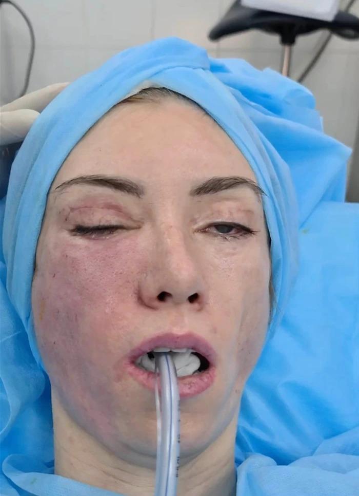 Á Hậu nghiện PTTM rồi chịu hậu quả mặt đơ, mắt trợn ngược-4