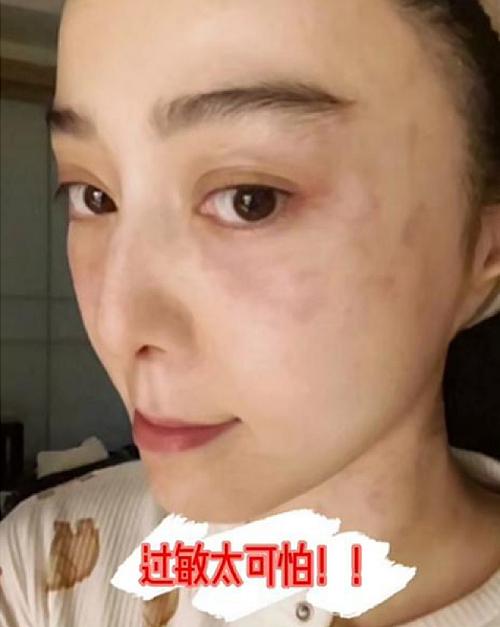 Phạm Băng Băng dị ứng sưng húp mặt-1