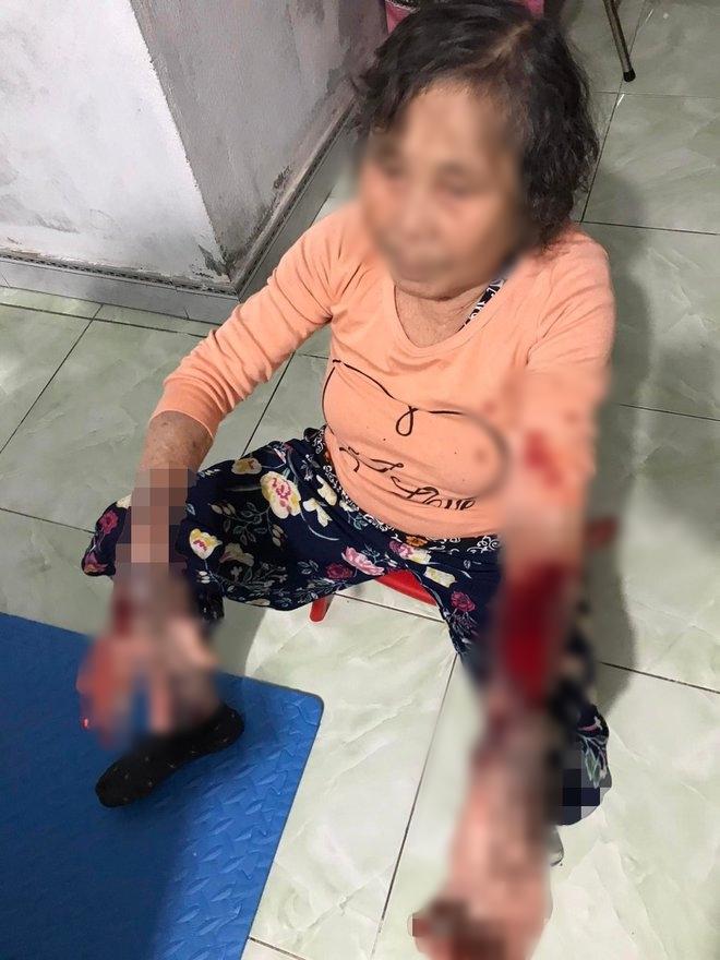 Nhắc nhở hàng xóm hát karaoke quá to, cụ bà 83 tuổi bị đánh bầm tím người-1