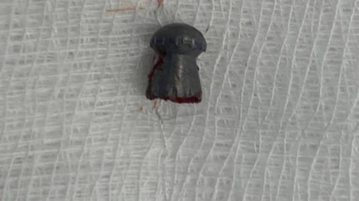 Đang làm ruộng, bất ngờ bị đạn lạc xuyên vùng kín-3