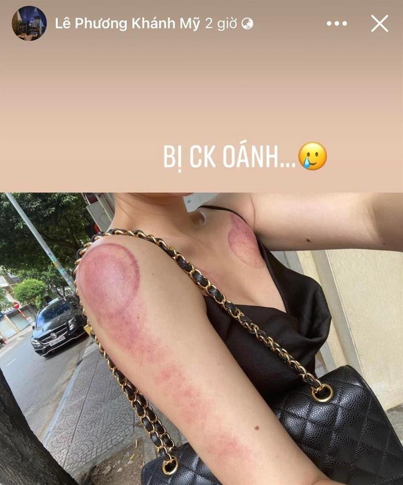 Vân Navy bị chồng đánh, thương tích đầy mình?-1