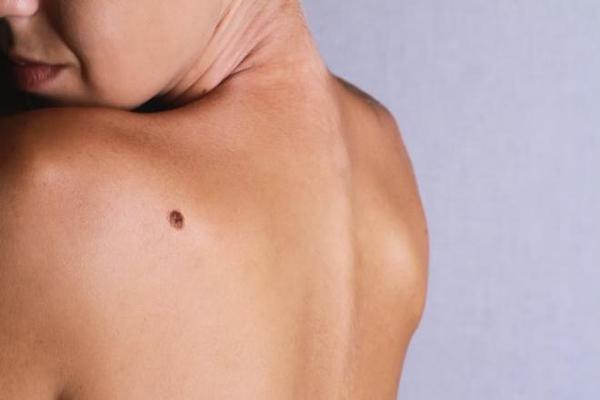 4 nốt ruồi cực xấu trên mặt đàn ông là khắc tinh của phụ nữ-3