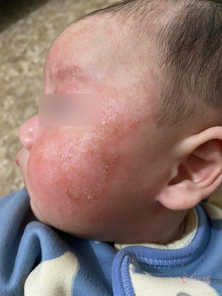 Abstain from bathing for 6 days when infected with Covid-19, young skin is scaly and red-2