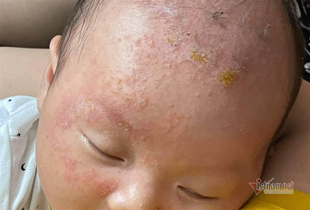 Abstain from bathing for 6 days when infected with Covid-19, the skin of the child is scaly and red-1