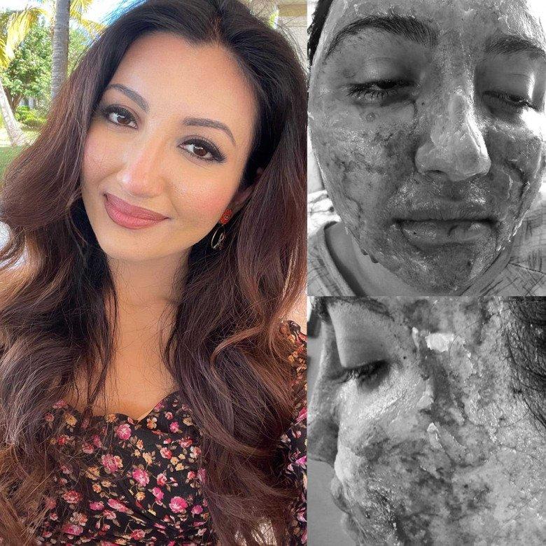 The miraculous show of the Miss World runner-up after a serious burn accident-5