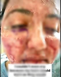 Màn tuốt mặt kỳ diệu của Á hậu Miss World sau tai nạn bỏng nặng-6