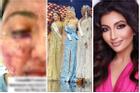 Màn 'tuốt mặt' kỳ diệu của Á hậu Miss World sau tai nạn bỏng nặng
