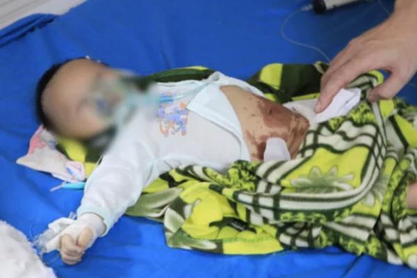 Bé 2 tháng tuổi nguy kịch sau khi được đắp tỏi trị Covid-19-1
