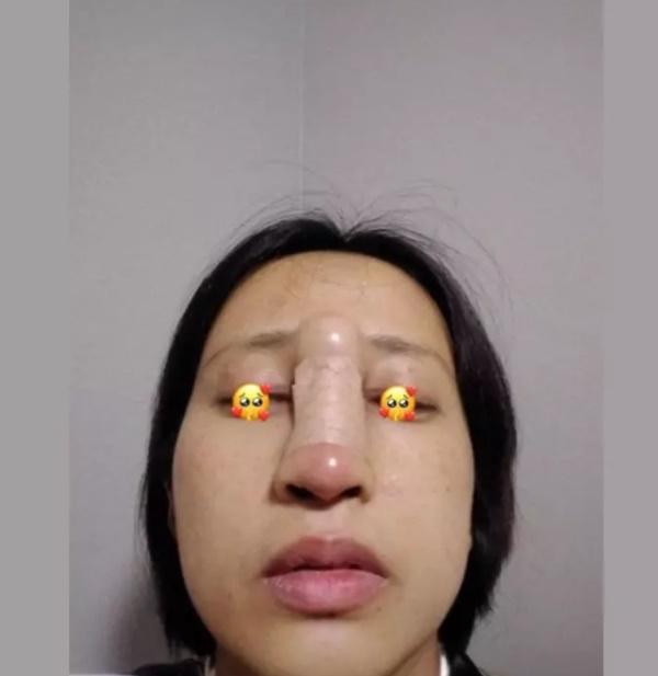 Kinh hãi clip cô gái nắn bóp miếng sụn sau khi nâng mũi-1