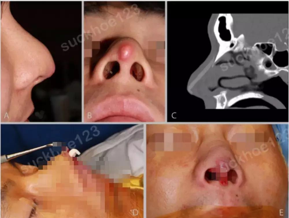 Kinh hãi clip cô gái nắn bóp miếng sụn sau khi nâng mũi-5