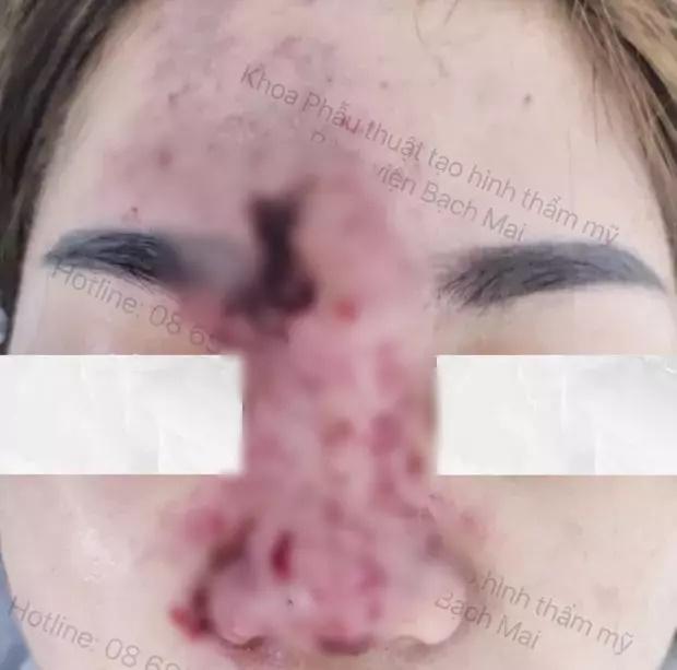 Kinh hãi clip cô gái nắn bóp miếng sụn sau khi nâng mũi-3