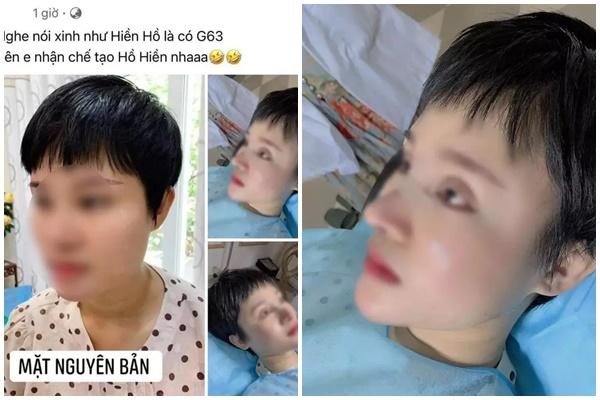 Hết hồn chiến tích xương xẩu sau gọt hàm, hạ gò má của chị em-7